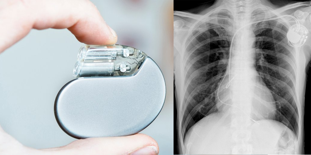Pacemakers and Implantable Defibrillators as related to Congestive ...