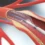 Stent-Free Coronary Angioplasty: Leaving Nothing Behind